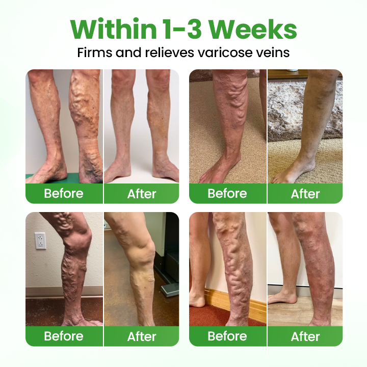 Healrize® VeinHeal Microneedle Patch ❤️