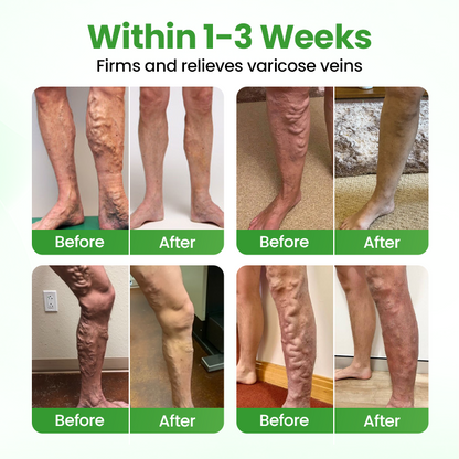 Healrize® VeinHeal Microneedle Patch ❤️