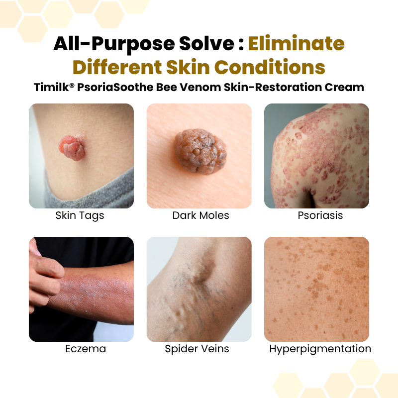 Timilk® PsoriaSoothe Bee Venom Skin-Restoration Cream ❤️