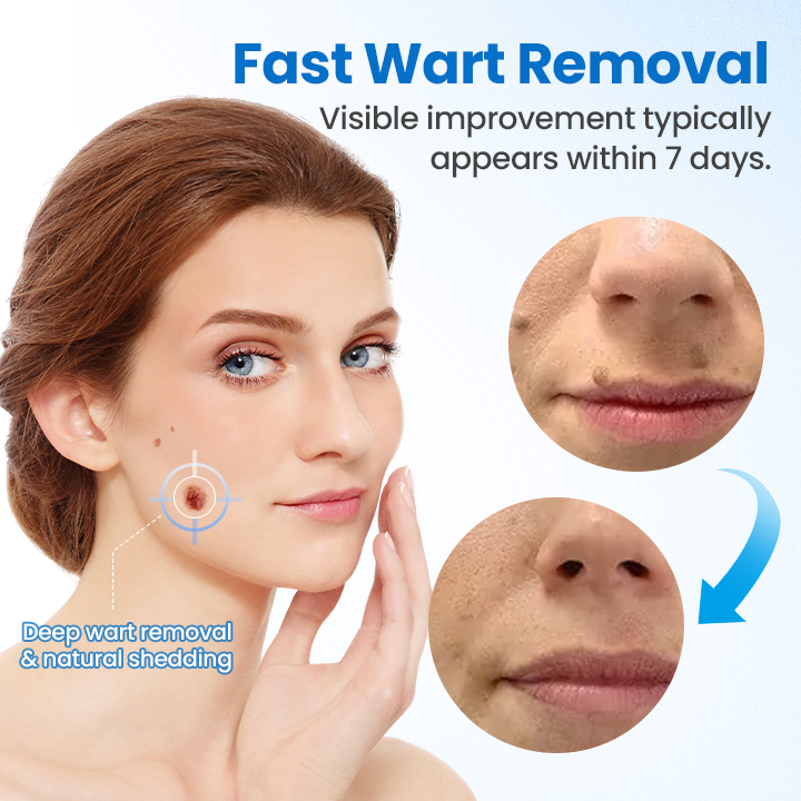 Timilk® TagGone Wart Removal Cream ❤️