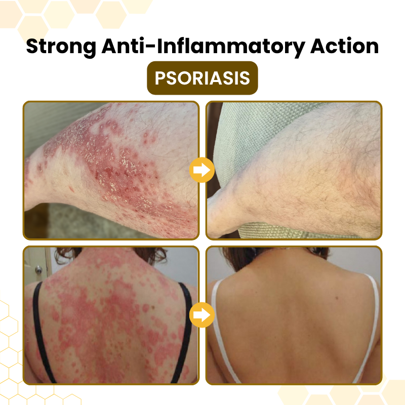 Timilk® PsoriaSoothe Bee Venom Skin-Restoration Cream ❤️