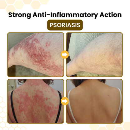 Timilk® PsoriaSoothe Bee Venom Skin-Restoration Cream ❤️