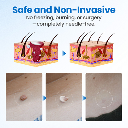 Timilk® TagGone Wart Removal Cream ❤️